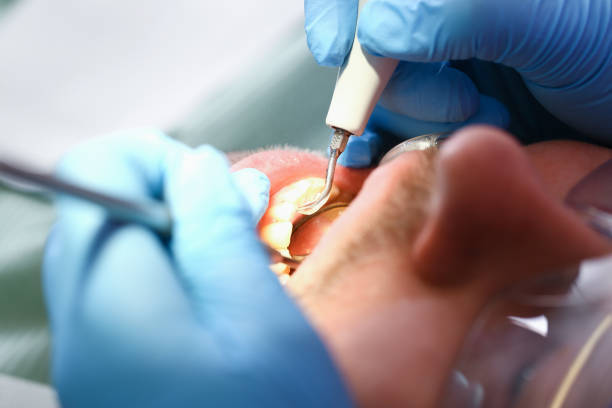Best Emergency Dental Care for Broken or Chipped Teeth in Bella Vista, CA